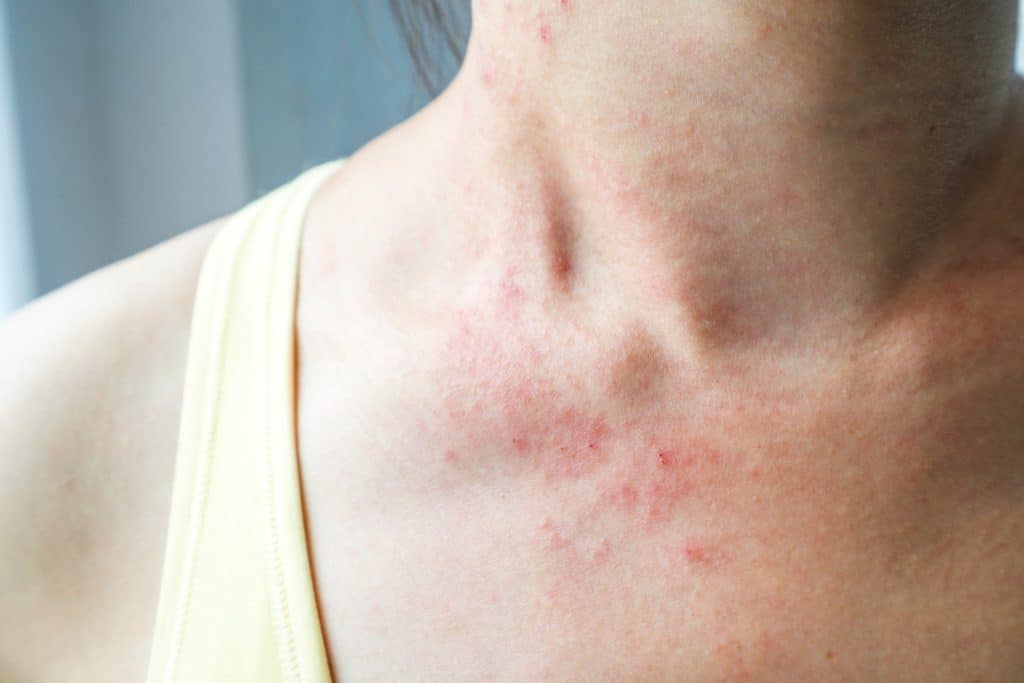 How To Avoid Keto Rash