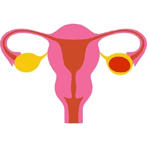 PCOS